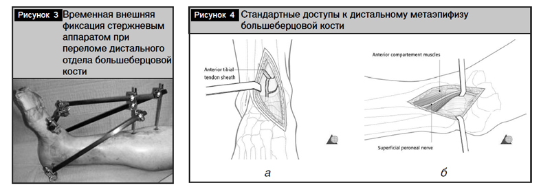 Большеберцовая кость фото на человеке